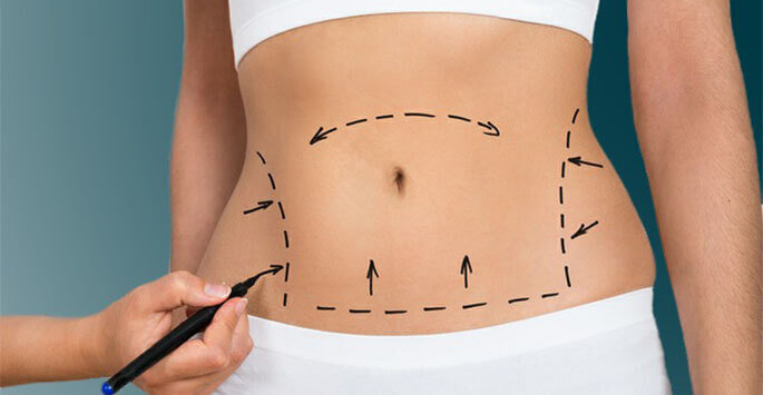 Abdominoplasty - The Tummy Tuck Procedure For Those Dream Abs!