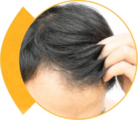 Hair Transplant