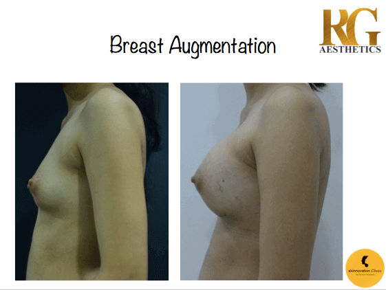 Skinnovation Clinics - Before and after of a Breast Transformation