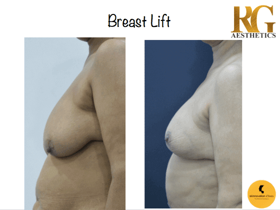 Skinnovation Clinics - Before and after of a Breast Transformation Surgery.  Many women suffer from sagging breasts. Either due to weight loss or post  pregnancy when their breast volume decreases. This can