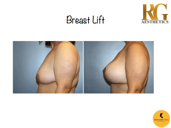 Skinnovation Clinics - Before and after of a Breast Transformation