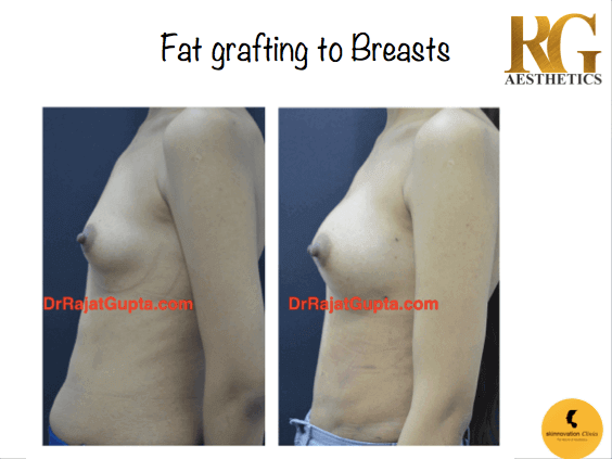 https://www.skinnovationclinics.com/wp-content/uploads/2019/04/Fat-qrafting-to-breast-2.png
