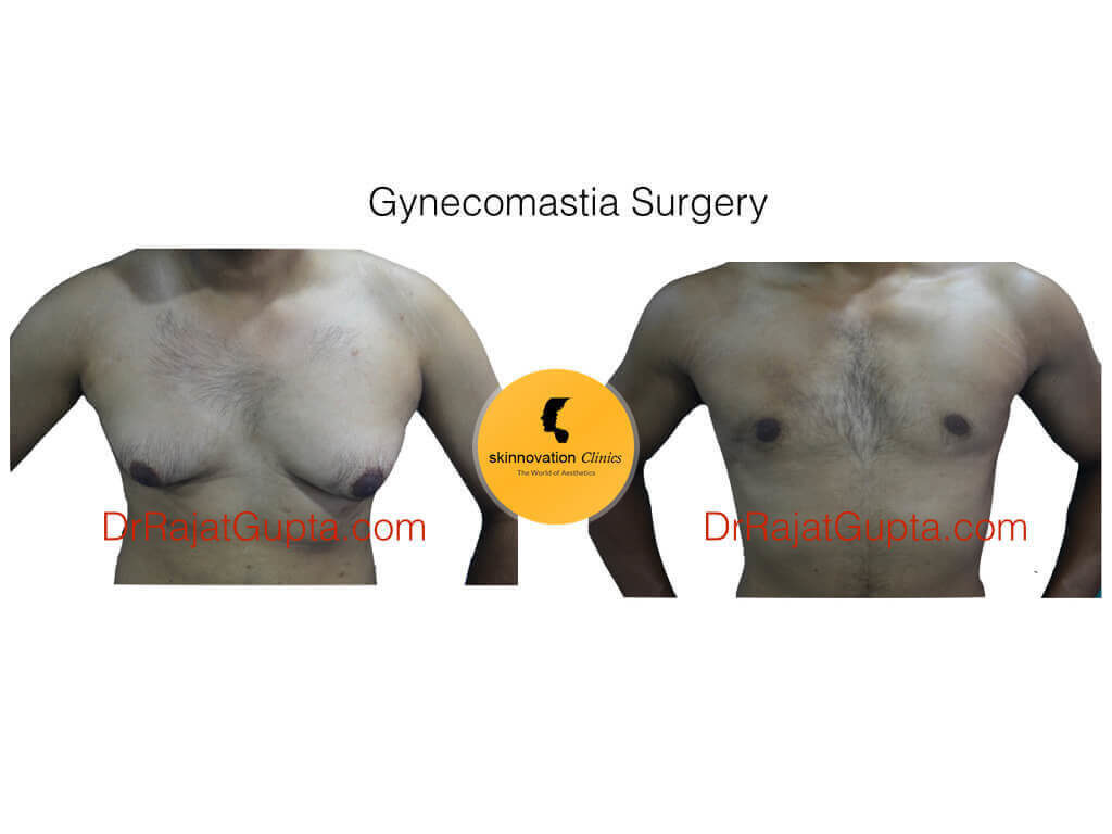 Skinnovation Clinics - Before and after of a Breast Transformation