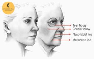 Dermal Fillers in Delhi, Dermal Fillers Treatment, Wrinkle Fillers